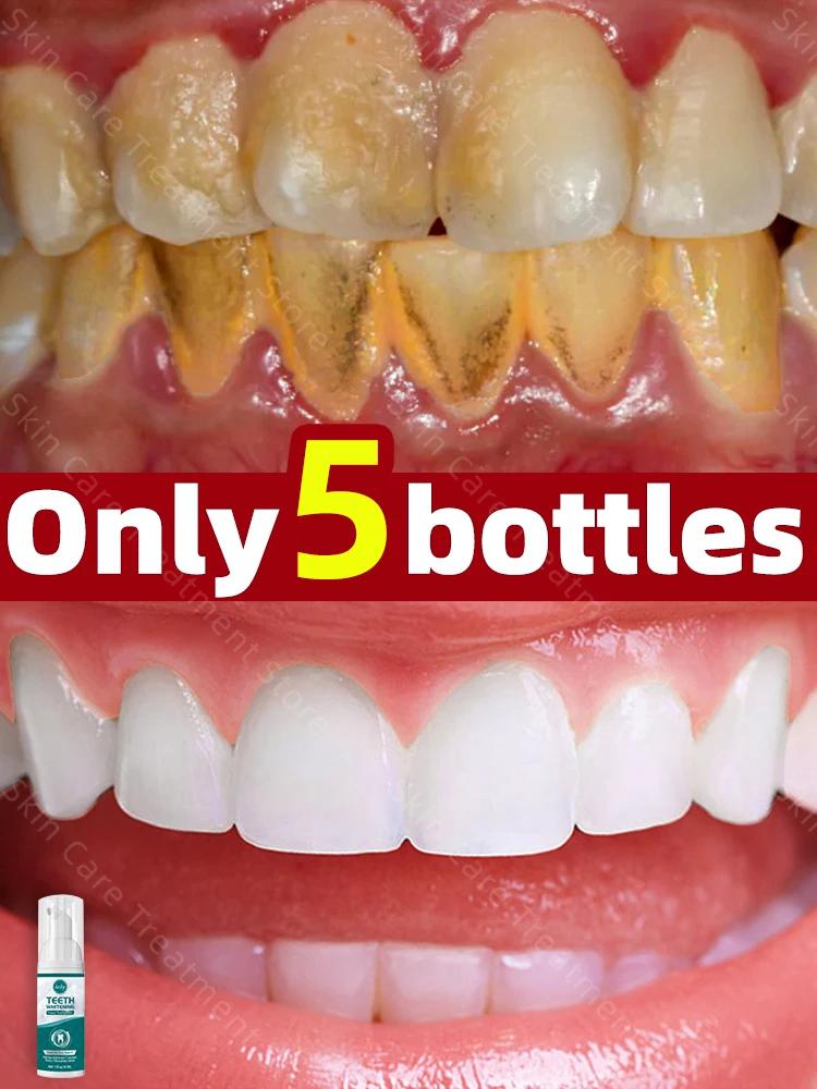 Higiene Oral, De Clearamento, Dente De Linpeza